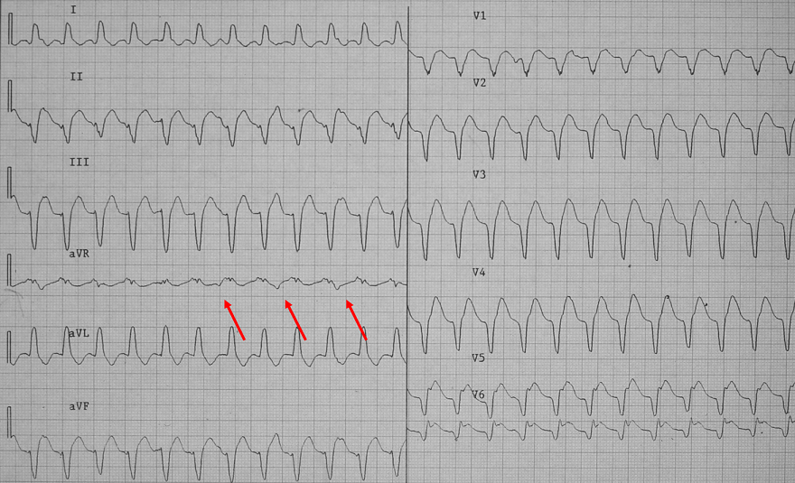 Wide complex tachycardia, Brugada algorithm, AV dissociation, RS complex - negative precordial concordance, ventricular tachycardia