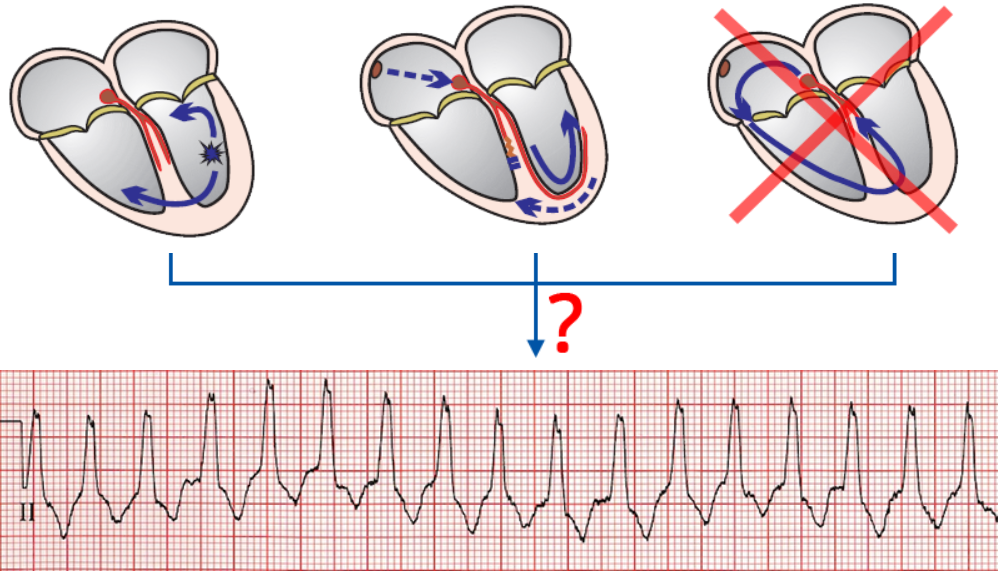 VT vs SVT with aberrancy criteria