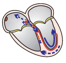 AVNRT, SVT with aberrant conduction - RBBB