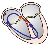 Antidromic AVRT, SVT with aberrant conduction due to the Wolff-Parkinson-White (WPW) syndrome