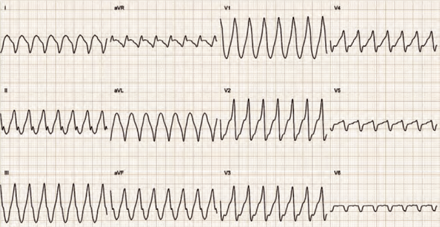 ECG DDx, Wide complex tachycardia, Brugada-Stuerer, Polarity QRS (V4-V6), qR complex (V2-V6), AV relationship, Preexcited SVT