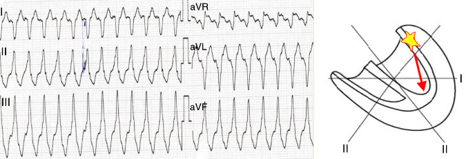 aVR algorithm - Vereckei, Ventricular tachycardia, base localised ectopic focus, negative QRS in aVR lead