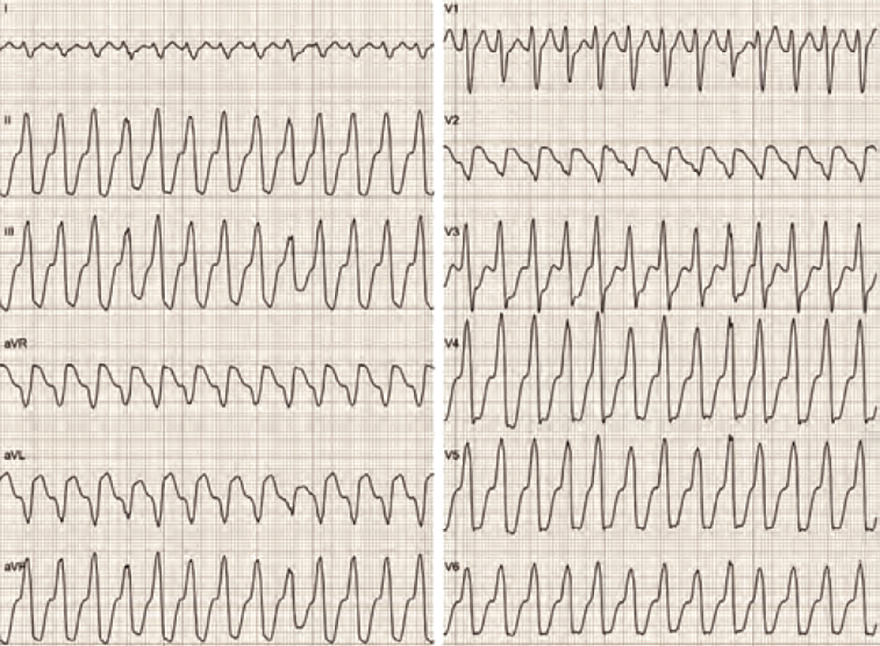 ECG DDx wide complex tachycardia, aVR Vereckei algorithm, Initial R wave, Initial r(q) 40ms, Ventricular tachycardia