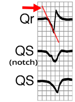 ECG Qr, QS, Lead aVR, slow depolarization from ventricular ectopic focus (ventricular tachycardia), Notch in descending limb, broad q(r) wave