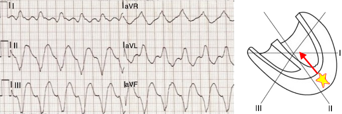 Ventricular tachycardia, aVR algorithm - Vereckei