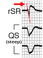 ECG fast depolarization, Lead II R wave peak time (RWPT) criterion, Pavas criteria, supraventricular tachycardia with aberrant conduction