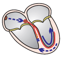 Lead II R wave peak time (RWPT) criterion, Pavas criteria, Wide complex tachycardia, SVT with aberrant conduction due to bundle branch block, RBBB, LBBB