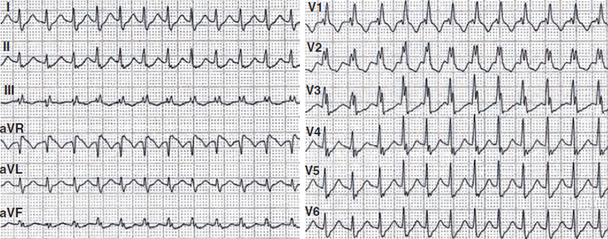 ECG wide QRS complex tachycardia (SVT with RBBB), SVT with RBBB - YES, Griffith (Bundle Branch Block) algorithm