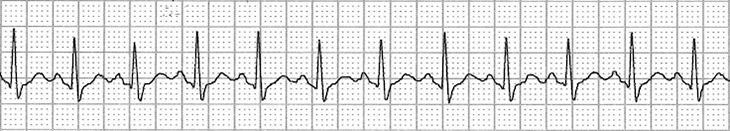 ECG sinoatrial nodal reentry tachycardia (sinus nodal reentrant), supraventricular tachycardia (SVT) arrhythmia