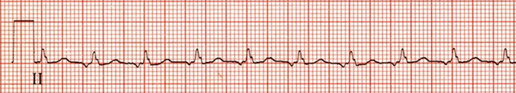 ECG Intra-atrial reentrant tachycardia, supraventricular tachycardia (SVT) arrhythmia