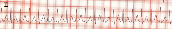 ECG Orthodromic Atrioventricular Reentrant Tachycardia (AVRT) , WPW syndrome, bundle of Kent