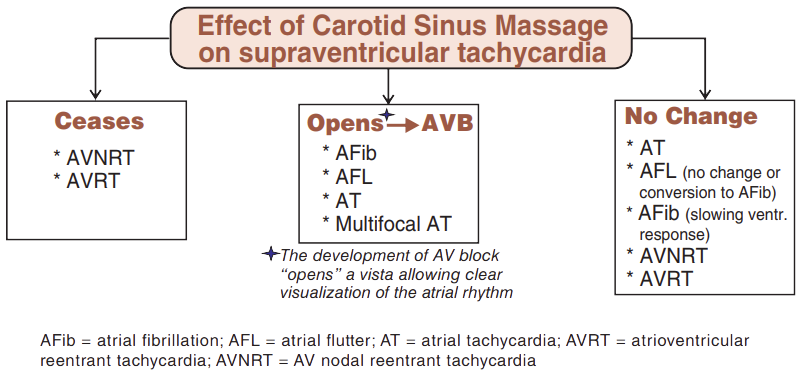 Effect of carotid sinus massage on narrow supraventricular (SVT) tachycardia