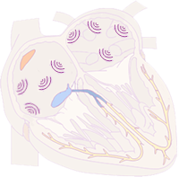 atrial fibrillation, micro re-entry, irregular supraventricular (SVT) tachycardia