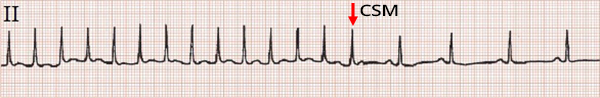 ECG carotid sinus massage, narrow complex tachycardia, typical AVNRT