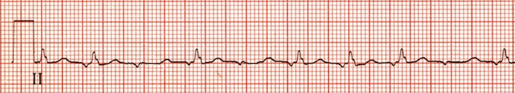 ECG ectopic atrial tachycardia with varying AV block, irregular narrow complex QRS tachycardia