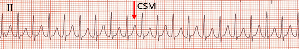 ECG carotid sinus massage on supraventricular tachycardia, no change