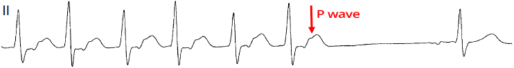 ECG narrow complex tachycardia, massage carotid sinus, termination with P wave, orthodromic AVRT