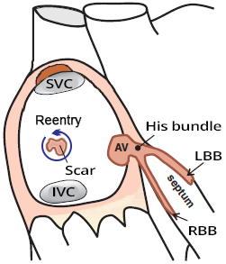 SA node, atrial scar, Intra-atrial reentry/reentrant tachycardia (IART)