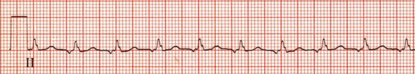 ECG Intra-atrial reentry/reentrant tachycardia (IART), abnormal P wave