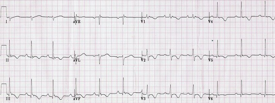 ECG (V1-V3) arrhythmogenic right ventricular hypertrophy, epsilon wave, inverted T wave