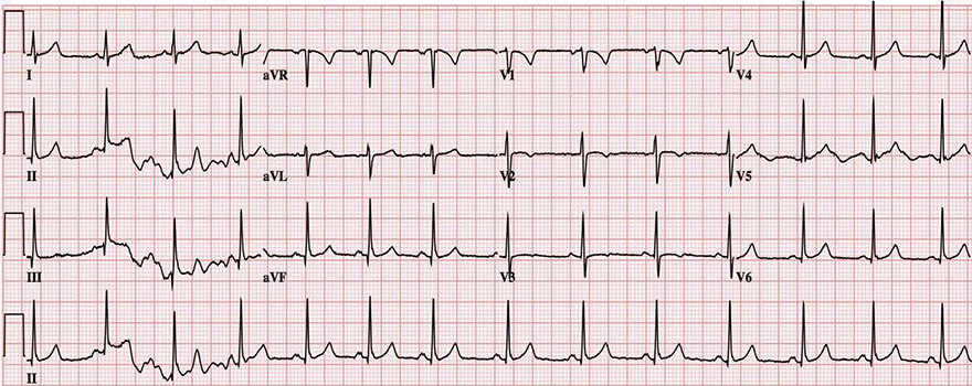 ECG (V1-V3) persistent juvenile T wave pattern, shallow asymmetric morphology inversions T waves (V1-V3), no significant ST segment