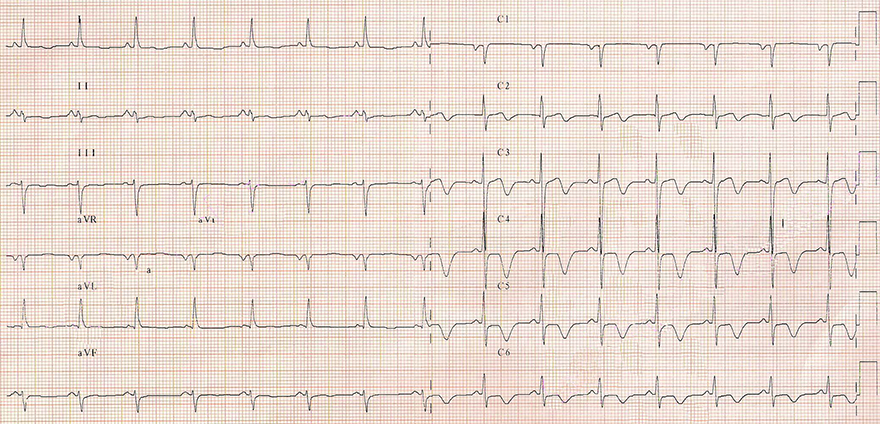 ECG ischemic inverted T waves, unstable angina pectoris, stenosis LAD, LCx