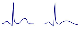 Hyperventilation-induced T Wave Inversion - ECG book