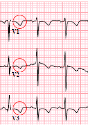 Hyperventilation T wave inversion