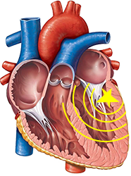 ectopic ventricular tachycardia focus, heart base, inferior wall, left ventriculi