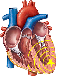 ectopic ventricular tachycardia focus, heart apex, inferior wall, left ventriculi