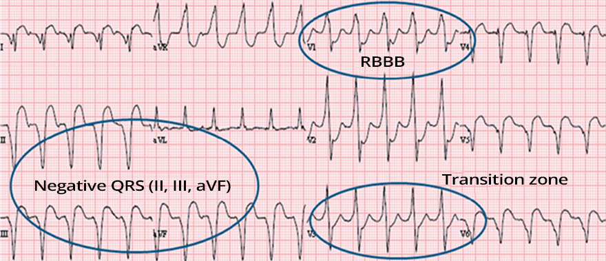 ECG ventricular tachycardia RBBB pattern, superior axis, Transition zone V3