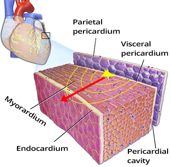 Epicardial ectopic focus locasisation, ventricular tachycardia, Localisation of the origin of a ventricular tachycardia, ectopic focus