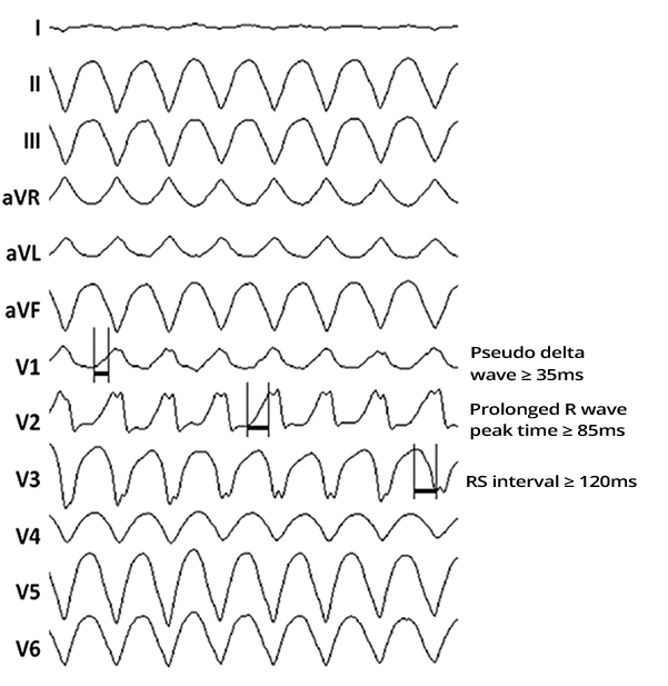 ECG epicardial ventricular tachycardia, pseudo delta wave, RS interval, Intrinsicoid deflection, 