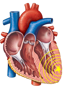 Localisation of the origin of a ventricular tachycardia, ectopic focus